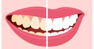 before and after whitening illlustration