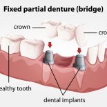 Fixed partial denture (bridge) image